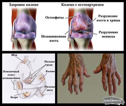 polyosteoarthrosis kezelés polyosteoarthrosis kezelés
