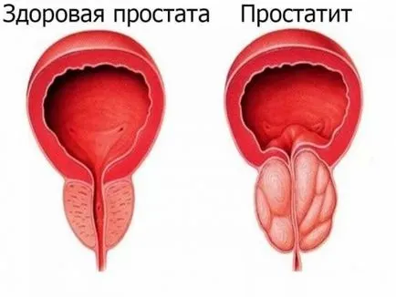 A prosztatagyulladás tünetei férfiaknál