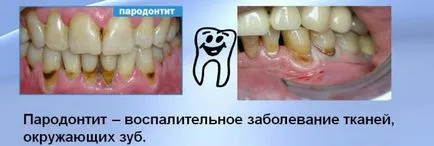 periodontitis fokozat