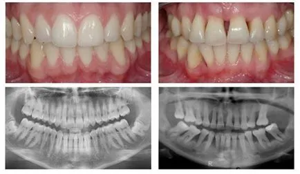periodontitis fokozat
