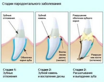 periodontitis fokozat