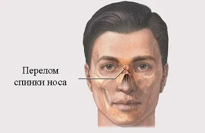 Mi a teendő, ha egy törött orr