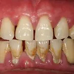 periodontitis fokozat periodontitis fokozat