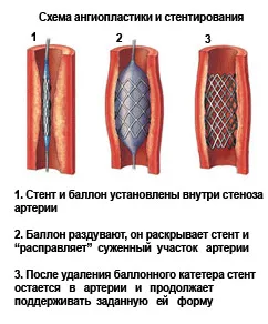 Sztentelése szívroham után Sztentelése szívroham után