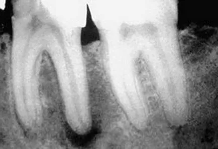 periodontitis fokozat