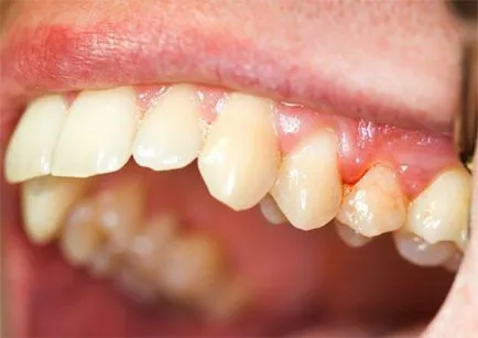 periodontitis fokozat periodontitis fokozat