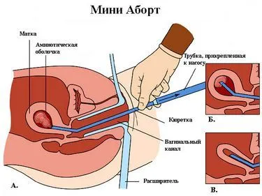 Hogyan lehet megszabadulni a nem kívánt terhesség otthon