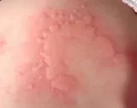 Allergiás érzéstelenítés Allergiás érzéstelenítés