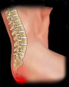 Coccyx fájdalom, mint a kezelésére Coccyx fájdalom, mint a kezelésére