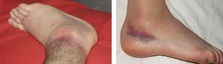 Abból, amit fáj a boka