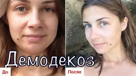 Akne, ami bennük van Akne, ami bennük van