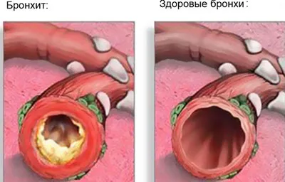 Hogyan kell kezelni a hörghurut bronchitis