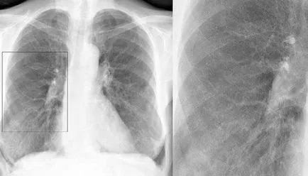 Hogyan kell kezelni a hörghurut bronchitis