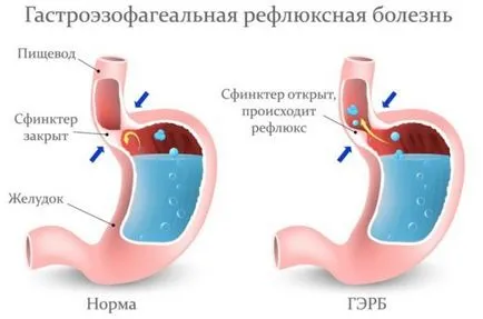 Hogyan kell kezelni a hörghurut bronchitis