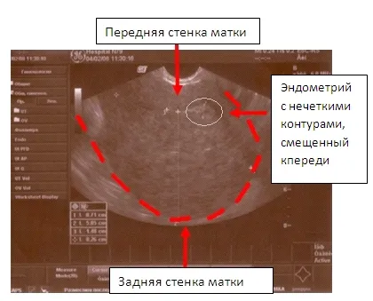Uzi endometriózis