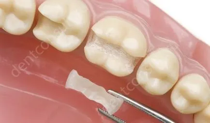 Protézis vagy implantáció