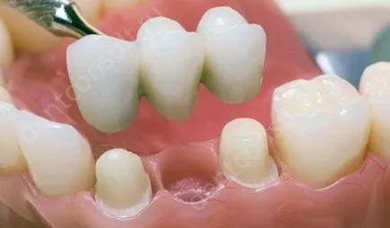 Protézis vagy implantáció
