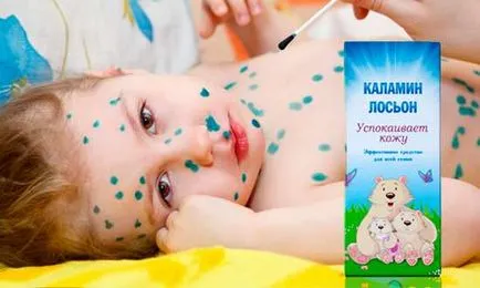 Milyen tünetei vannak a bárányhimlő gyermekek és felnőttek tünetei fotók