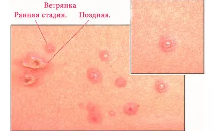 Milyen tünetei vannak a bárányhimlő gyermekek és felnőttek tünetei fotók