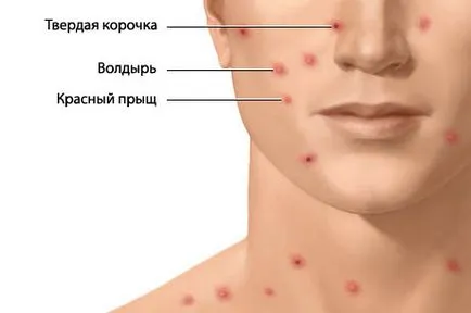 Milyen tünetei vannak a bárányhimlő gyermekek és felnőttek tünetei fotók