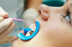 Hogyan erősíthető és újjáépíteni fogzománc