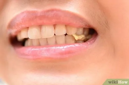 Erősítése a fogzománc (zománc) Hogyan lehet erősíteni a fogzománcot