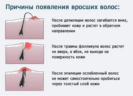 Hogyan lehet eltávolítani a benőtt szőr a bikinivonal