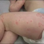 Mi urticaria felnőttek és gyermekek (fotó)
