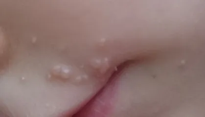 Mi molluscum contagiosum, és hogy el kell távolítani, a bőrt növedékek kell (külső) Mi molluscum contagiosum, és hogy szeretné-e törölni, növedékek a bőrön
