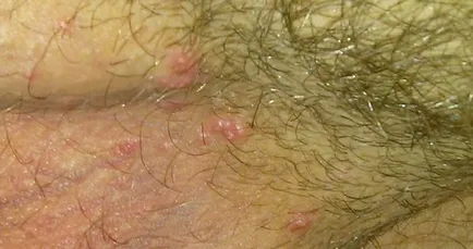 Mi molluscum contagiosum, és hogy el kell távolítani, a bőrt növedékek kell (külső) Mi molluscum contagiosum, és hogy szeretné-e törölni, növedékek a bőrön