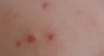 Mi molluscum contagiosum, és hogy el kell távolítani, a bőrt növedékek kell (külső) Mi molluscum contagiosum, és hogy szeretné-e törölni, növedékek a bőrön