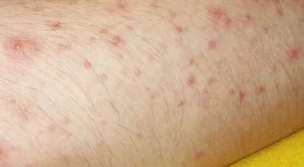 Mi molluscum contagiosum, és hogy el kell távolítani, a bőrt növedékek kell (külső) Mi molluscum contagiosum, és hogy szeretné-e törölni, növedékek a bőrön