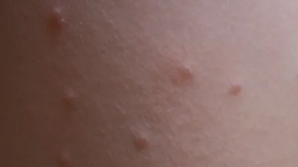 Mi molluscum contagiosum, és hogy szeretné-e törölni, bőr növedékek (kötelező) Mi molluscum contagiosum, és hogy szeretné-e törölni, növedékek a bőrön