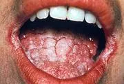 Candidiasis (szájpenész) - okai, tünetei, diagnózisa, kezelése, komplikációk és megelőzésére gomba