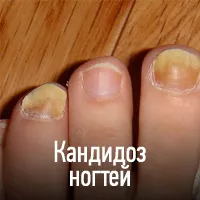 Candidiasis (szájpenész) - okai, tünetei, diagnózisa, kezelése, komplikációk és megelőzésére gomba