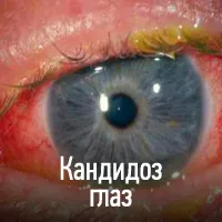 Candidiasis (szájpenész) - okai, tünetei, diagnózisa, kezelése, komplikációk és megelőzésére gomba