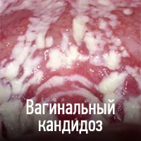 Candidiasis (szájpenész) - okai, tünetei, diagnózisa, kezelése, komplikációk és megelőzésére gomba
