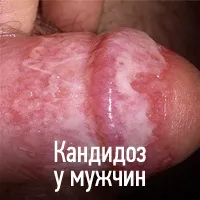 Candidiasis (szájpenész) - okai, tünetei, diagnózisa, kezelése, komplikációk és megelőzésére gomba