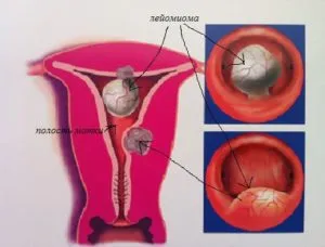 Calcified méhfibróma kezelési sajátosságai és Fejlesztési (hamu) Calcified méhfibróma kezelési sajátosságai és fejlesztési