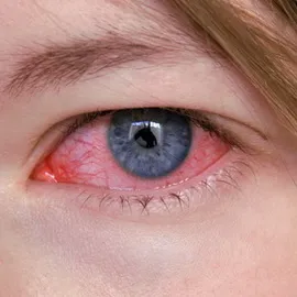 Keratitis fényképet szemek, tünetei, kezelése okoz herpeszes szaruhártya a szem, a diagnózis és (szaruhártya-gyulladás) Keratitis szem fotó, tünetei, kezelése okoz herpeszes szaruhártya a szem, a diagnózis és