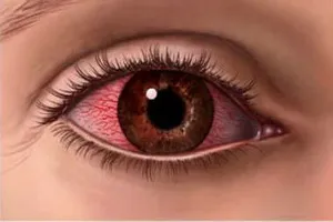 Keratitis szem fotó, a tünetek, a kezelés és okoz herpeszes keratitis, a szem, a diagnózis és (kezelés) Keratitis szem fotó, tünetei, kezelése okoz herpeszes szaruhártya a szem, a diagnózis és