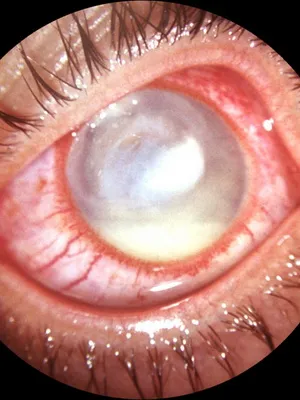 Keratitis szem fotó, a tünetek, a kezelés és okoz herpeszes keratitis, a szem, a diagnózis, és (fotó) Keratitis szem fotó, tünetei, kezelése okoz herpeszes szaruhártya a szem, a diagnózis és