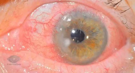 Keratitis, a tünetek, okok, kezelés keratitis