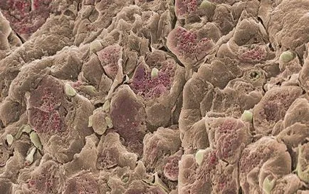 Osztályozása a krónikus pancreatitis, és alakja (osztályozás) Osztályozása a krónikus pancreatitis, illetve annak formái