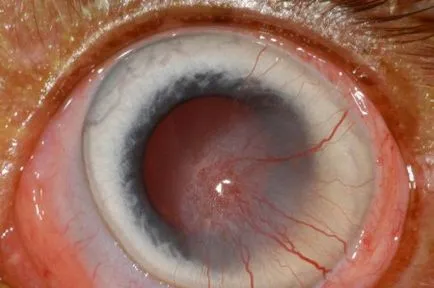 Keratitis szem tünetek és a kezelés
