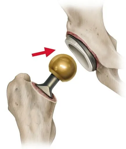 Ha szükséges csípőprotézis