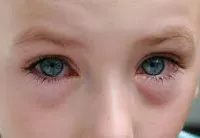 Kötőhártya Children - okai, tünetei, diagnózisa és kezelése