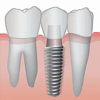 Teljes körű fogászati ​​implantátumok - fogak 4 nap!