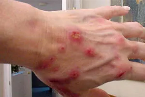 Kontakt dermatitis tünetei és kezelése bőrgyulladást okoz, azt jelenti, hatásos, ha