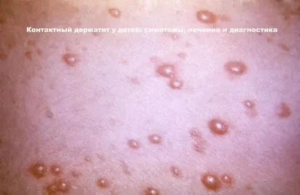 Kontakt dermatitis tünetei és kezelése gyermekeknél